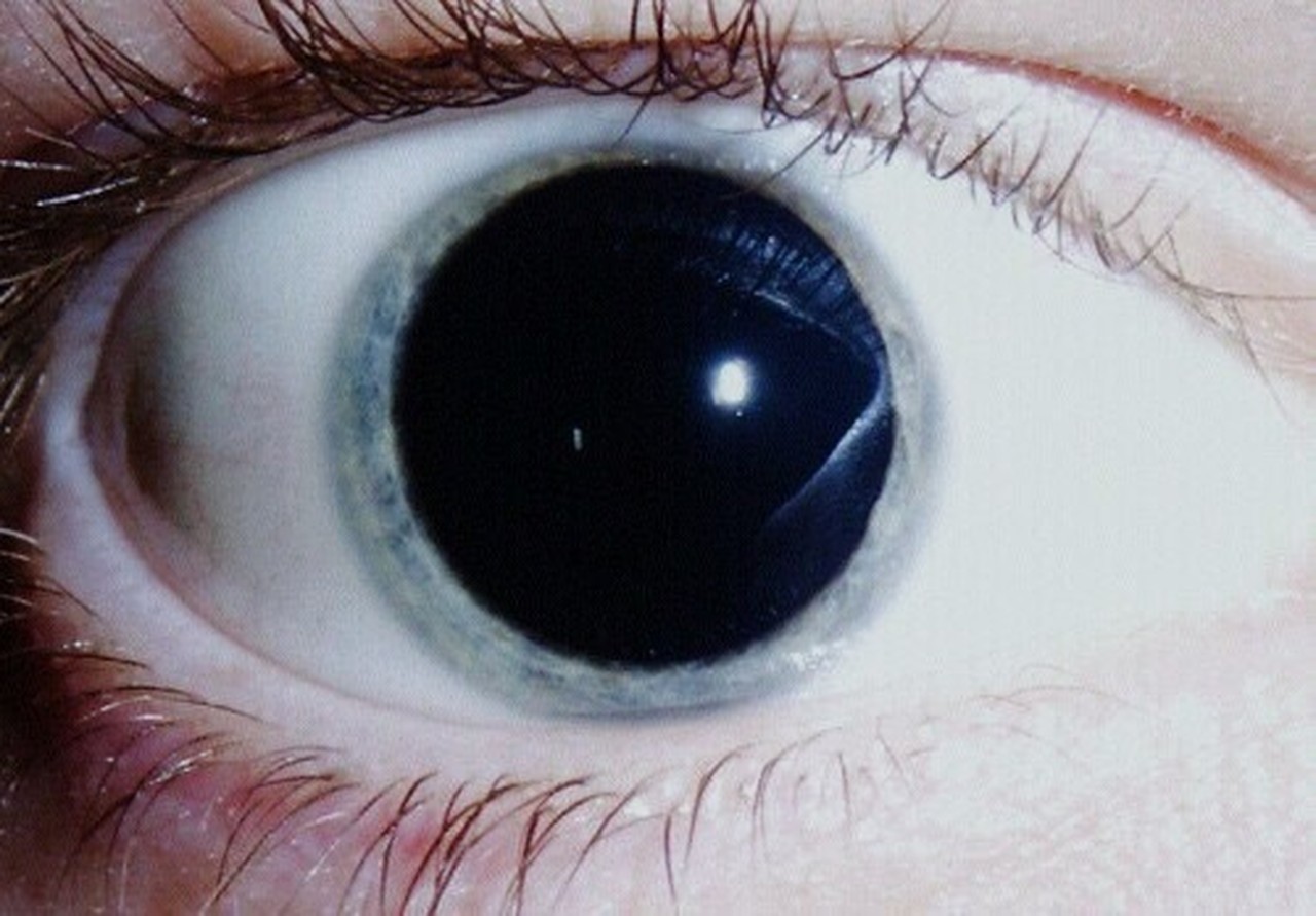 pupils on mdma