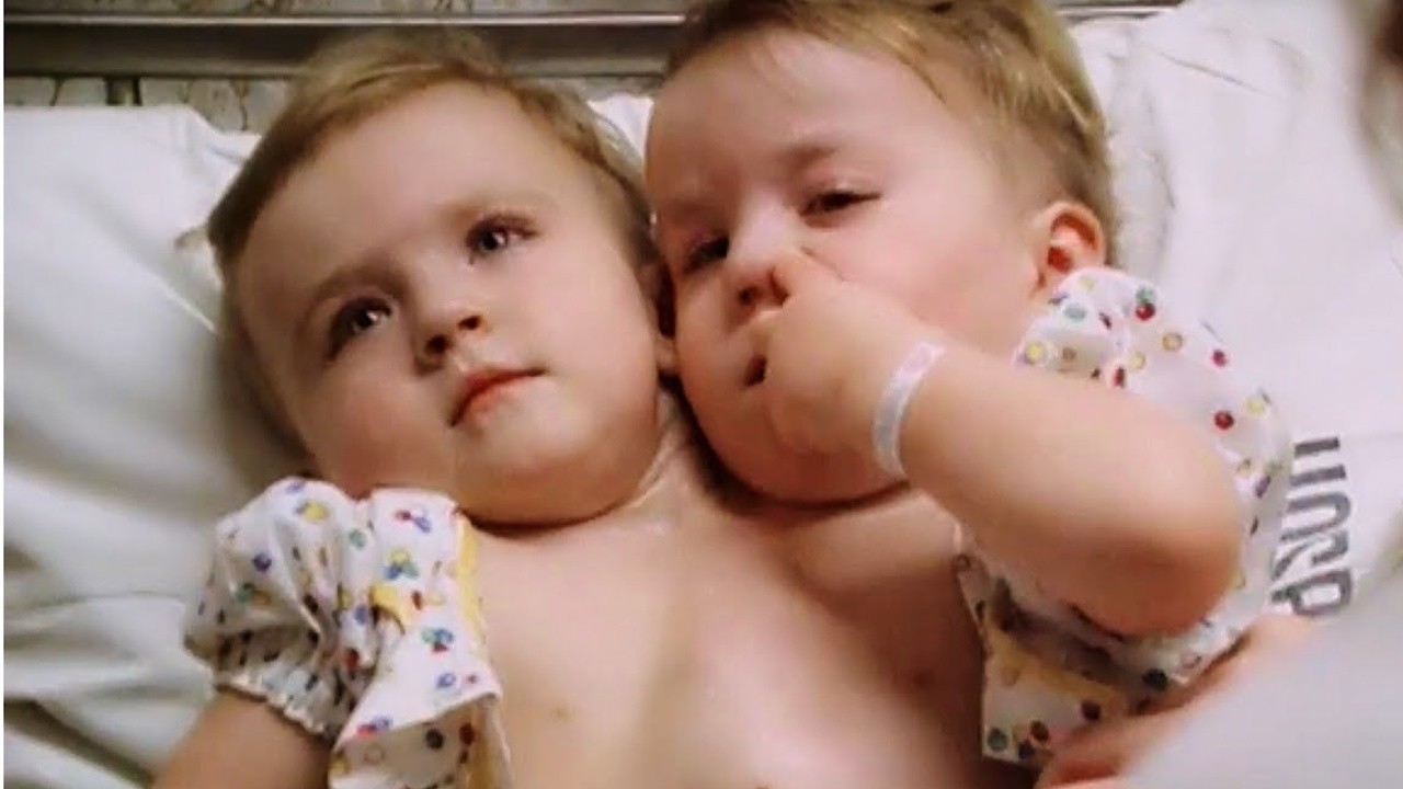 Katie and Eilish: Siamese Twins