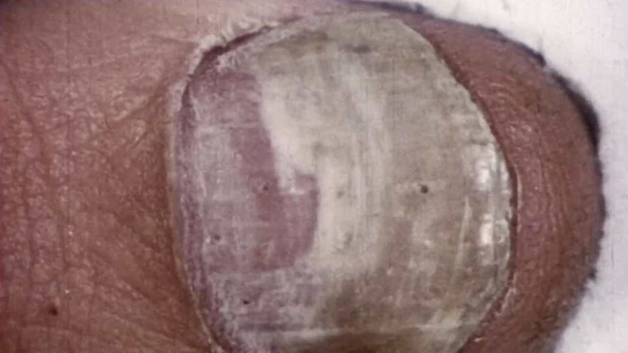 Time-lapse Photography of Nail Growth